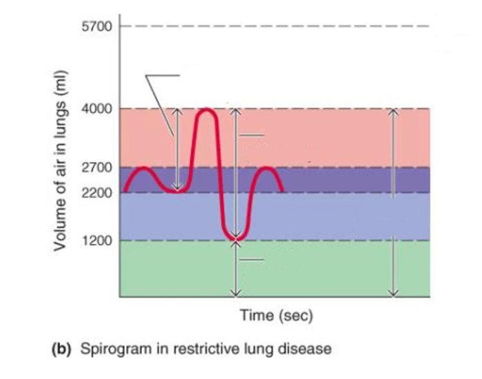 Spirogram in restrictive lung disease Quiz