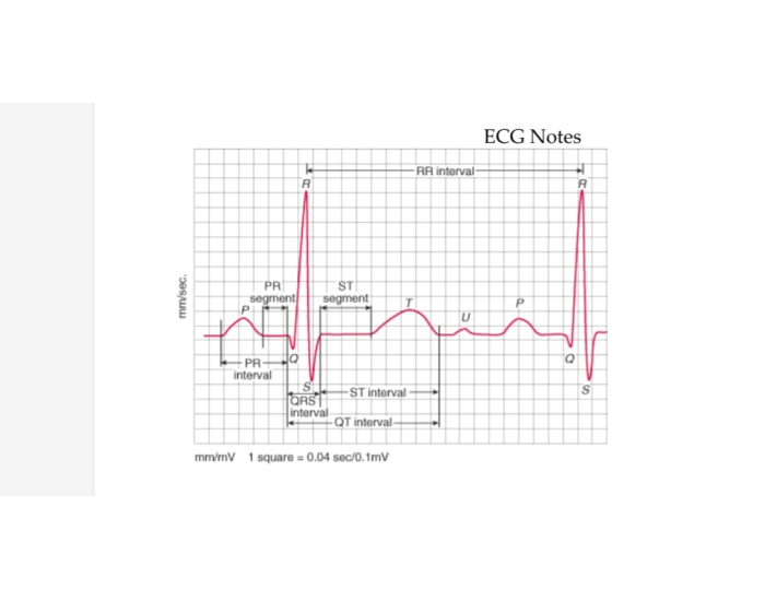 Ekg Example Graph EKG diagram graph Quiz