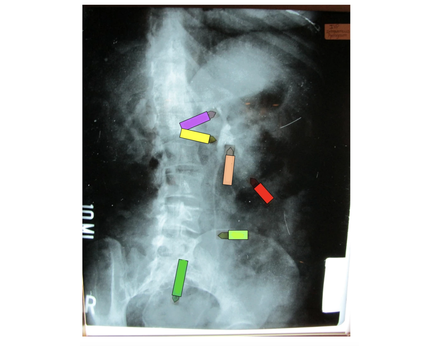 Pyelongram Intravenous pyelogram (IVP) Quiz