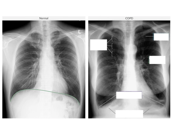 CXR: Normal VS COPD — Printable Worksheet