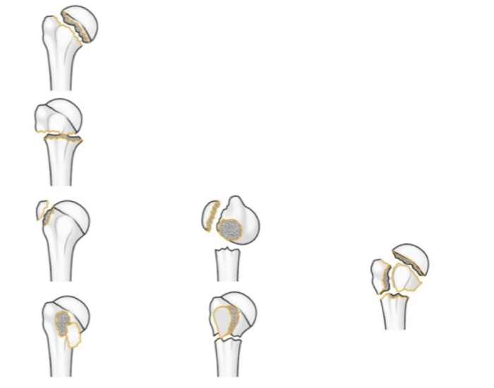 Neer classification of humeral fractures Quiz