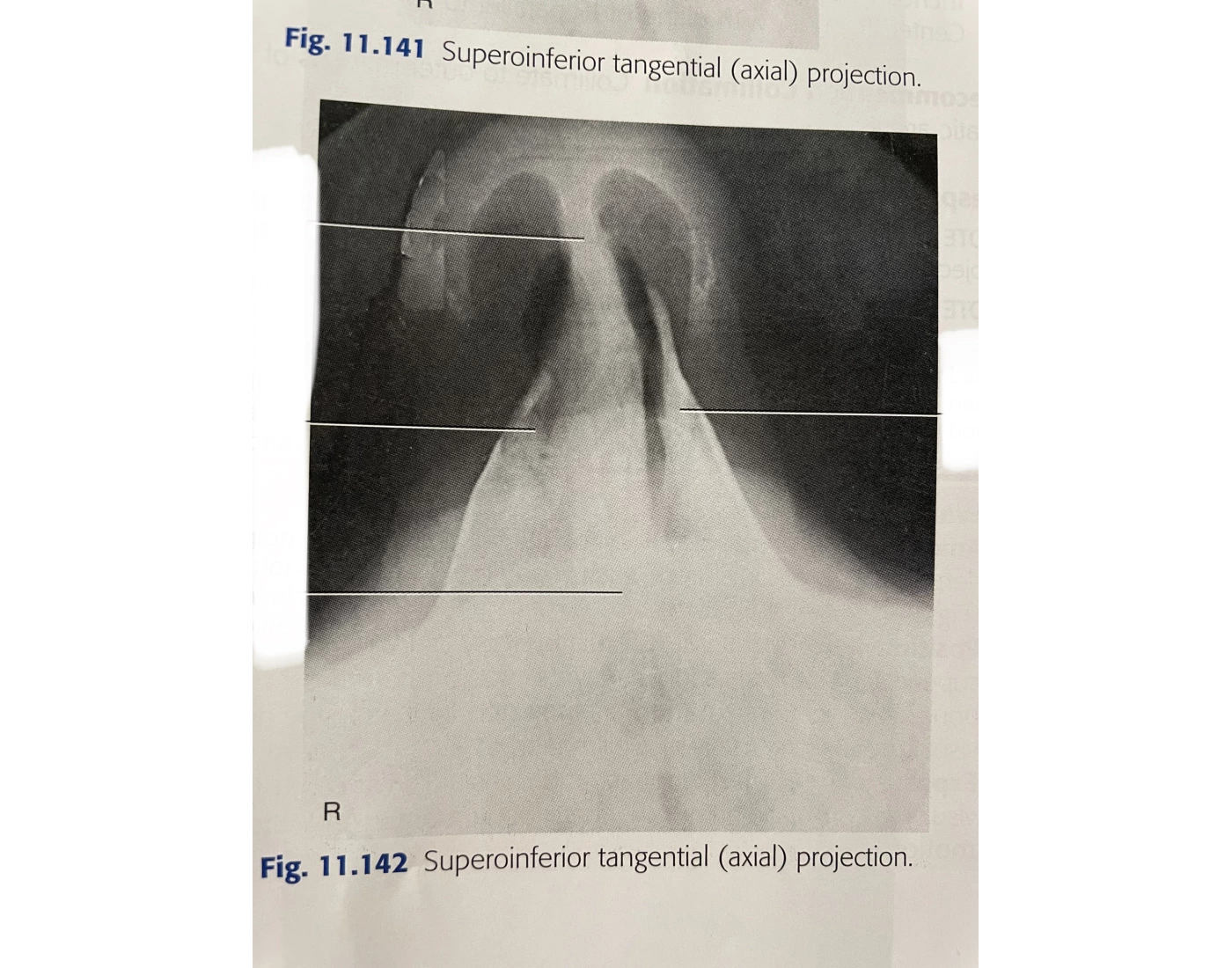 superiorinferior tangential (axial) projection nos Quiz