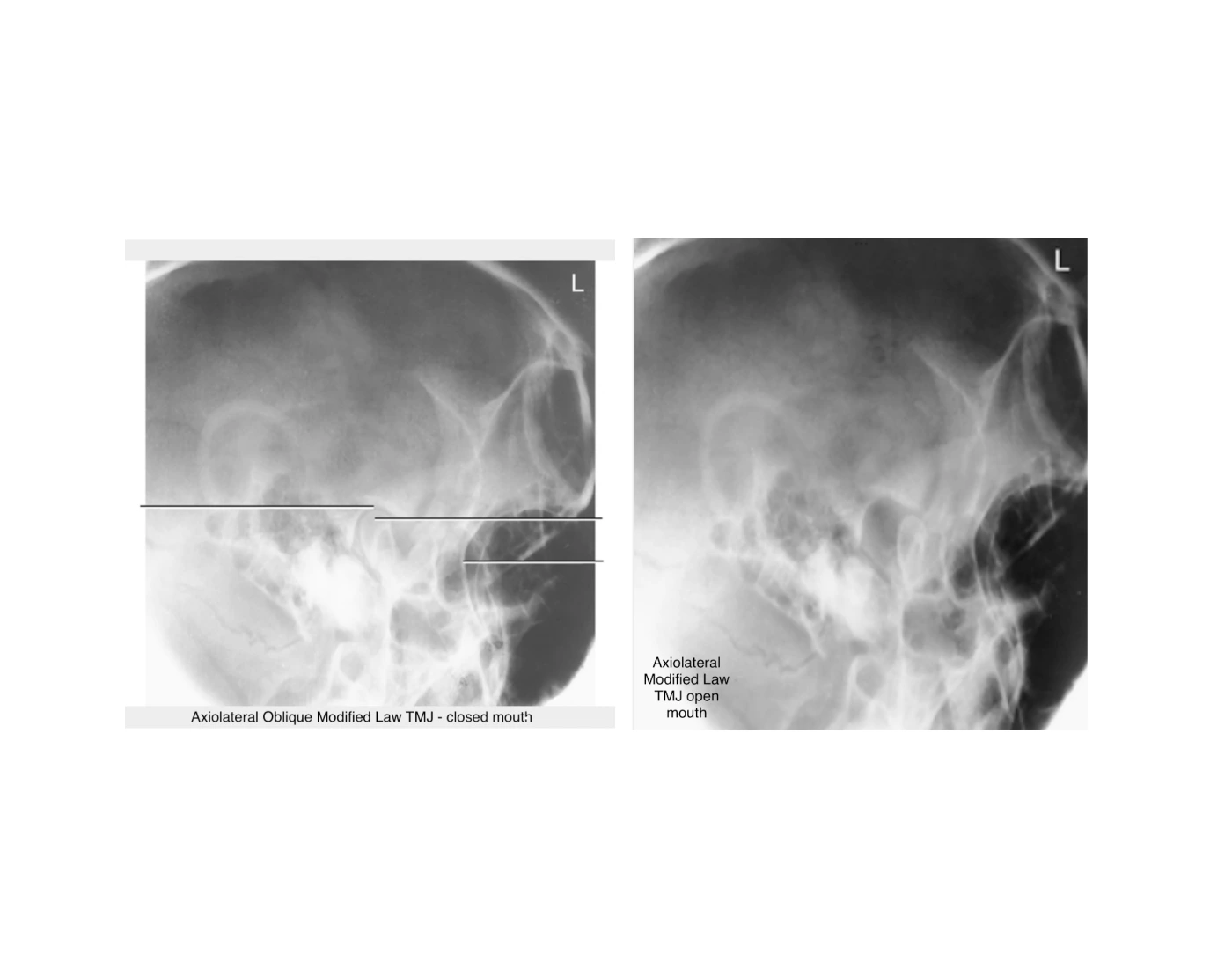 Axiolateral (schuller method) - TMJ Quiz