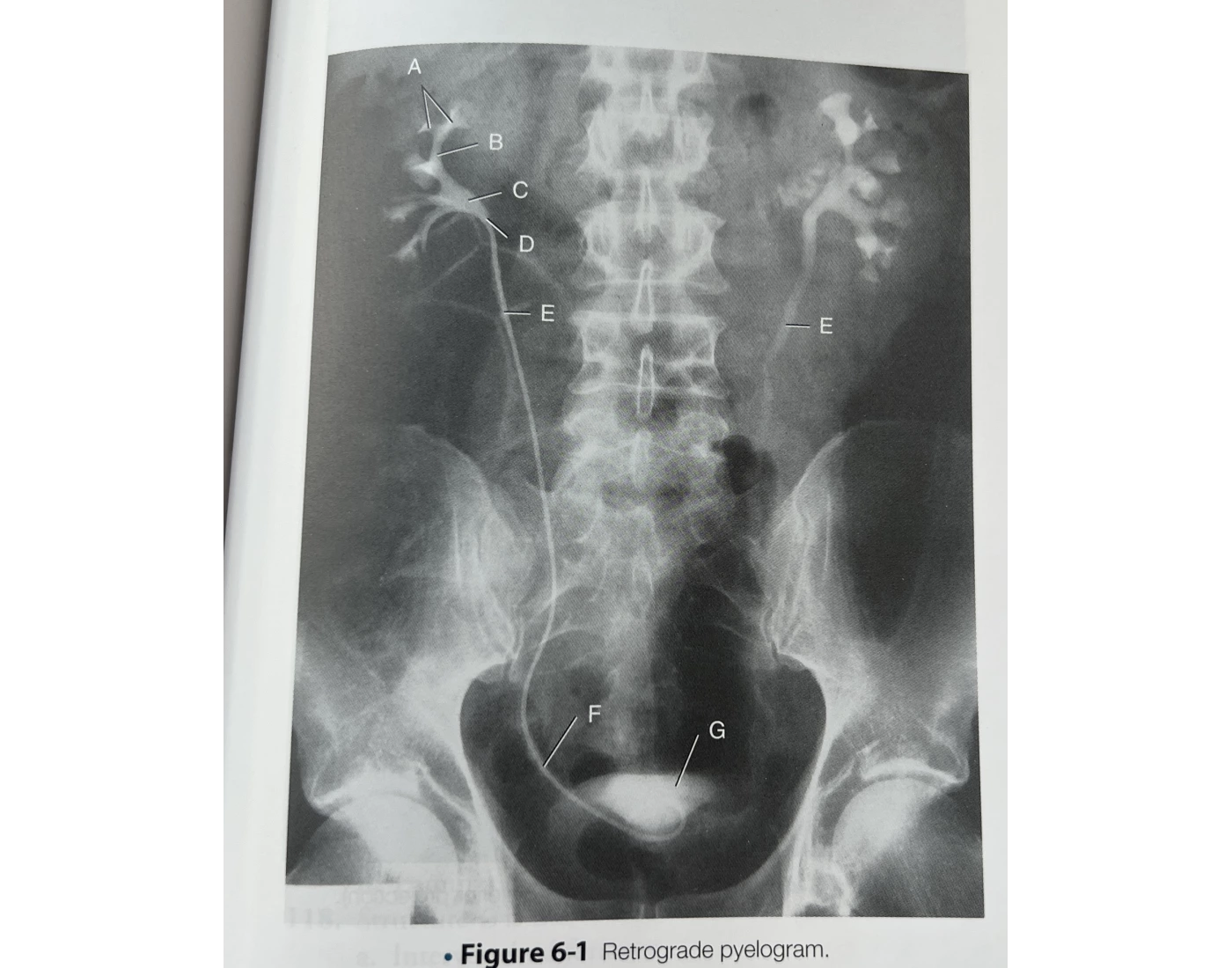 Retrograde Pyelogram Quiz