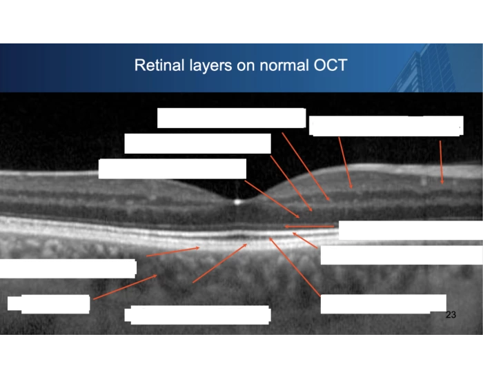 Optical coherence tomography (OCT) — Printable Worksheet