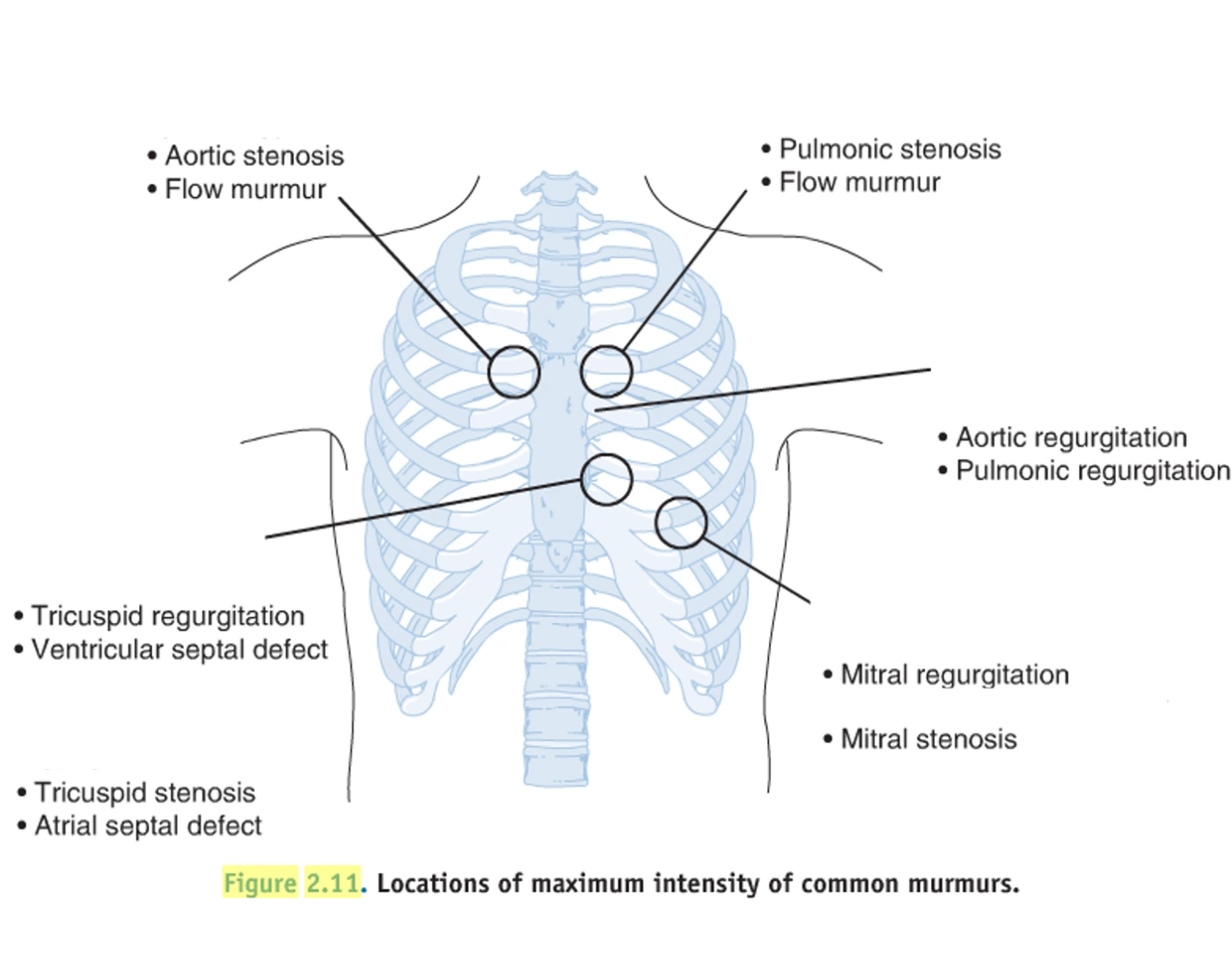 Murmuring Map Areas for Auscultation/Types of Murmur — Printable Worksheet