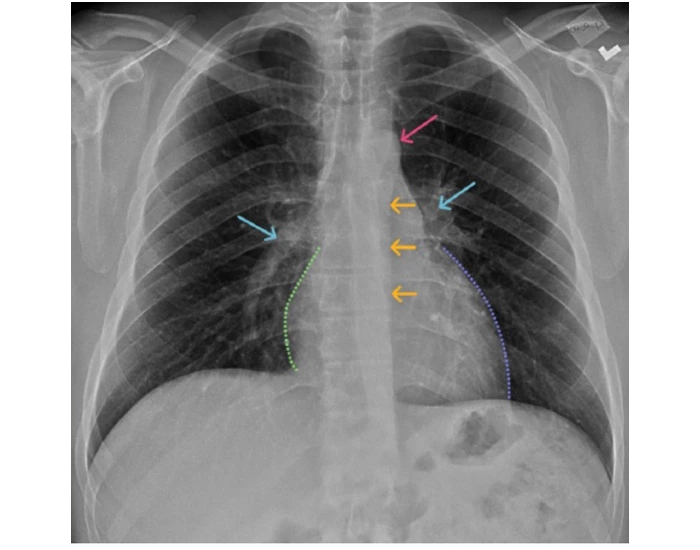 Pa Projection Program PA projection of cardiac anatomy 2 Quiz