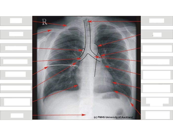 Pa Projection Program PA projection of cardiac anatomy 3 Quiz