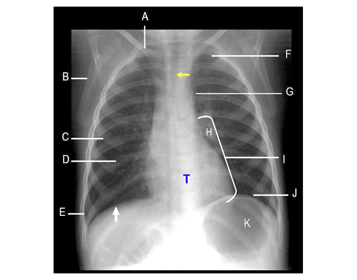Pa Projection Program PA projection of cardiac anatomy 5 Quiz