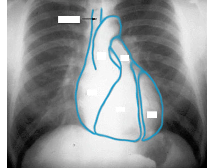 Pa Projection Program PA projection of cardiac anatomy 1 Quiz