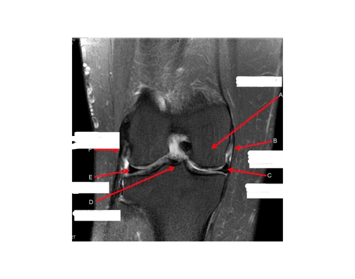 Pfd Rt Knee PD coronal With fat Suppression RT knee Quiz