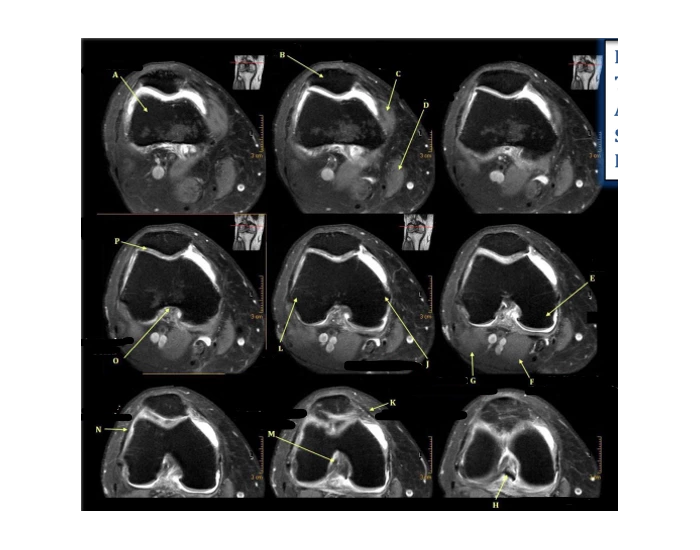 Pfd Rt Knee PD axial With fat suppression RT knee Quiz