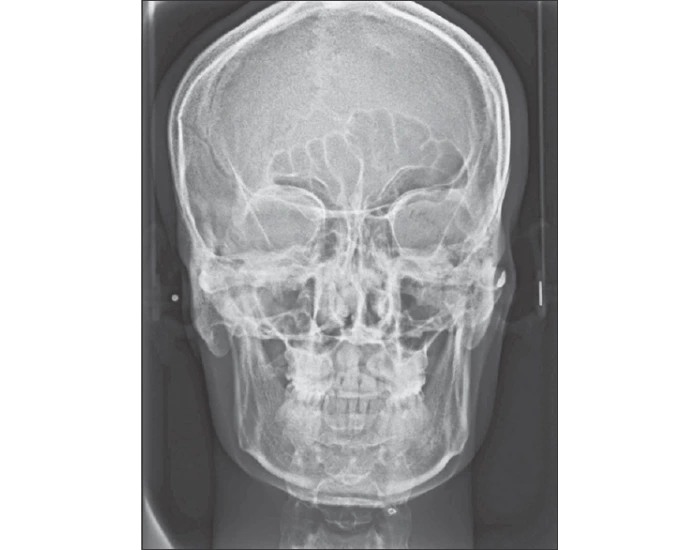 Caldwell skull X-ray Quiz