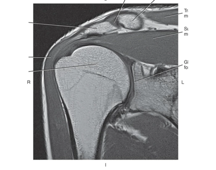 R Shoulder Rfa Coronal Oblique of R Shoulder w/AC joint Quiz