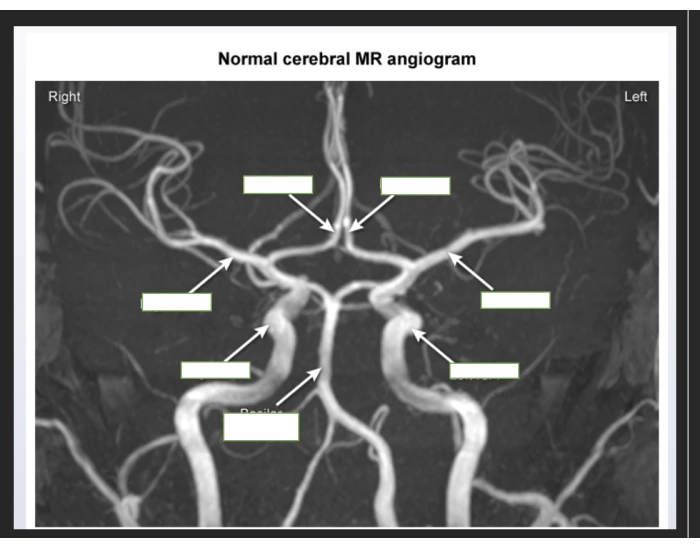 Normal Labelled Angiogram Normal Cerebral MR angiogram Quiz