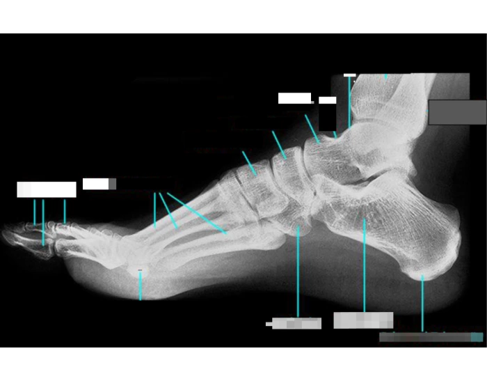 Foot bones radiograph — Printable Worksheet
