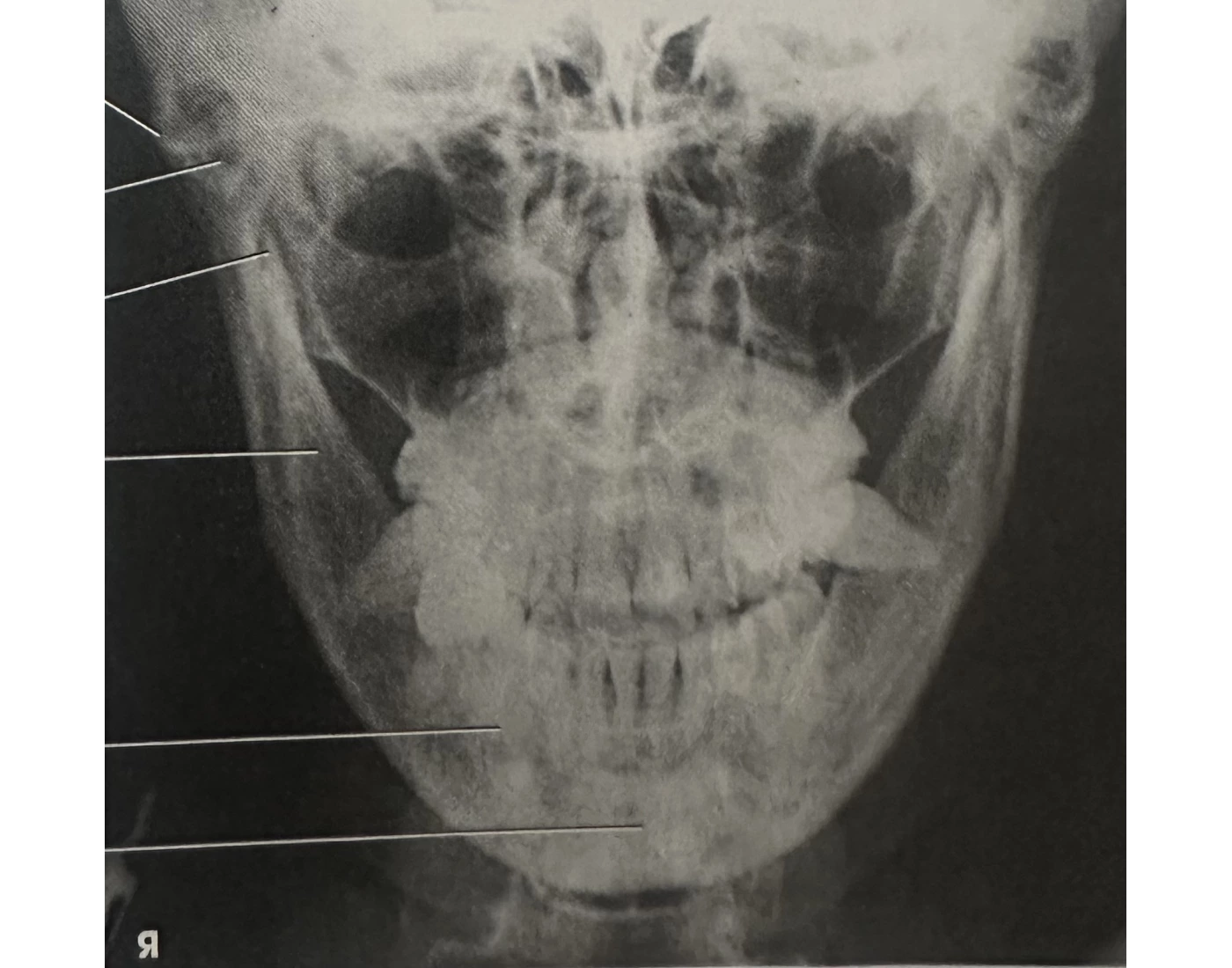 PA Axial mandibular rami Quiz