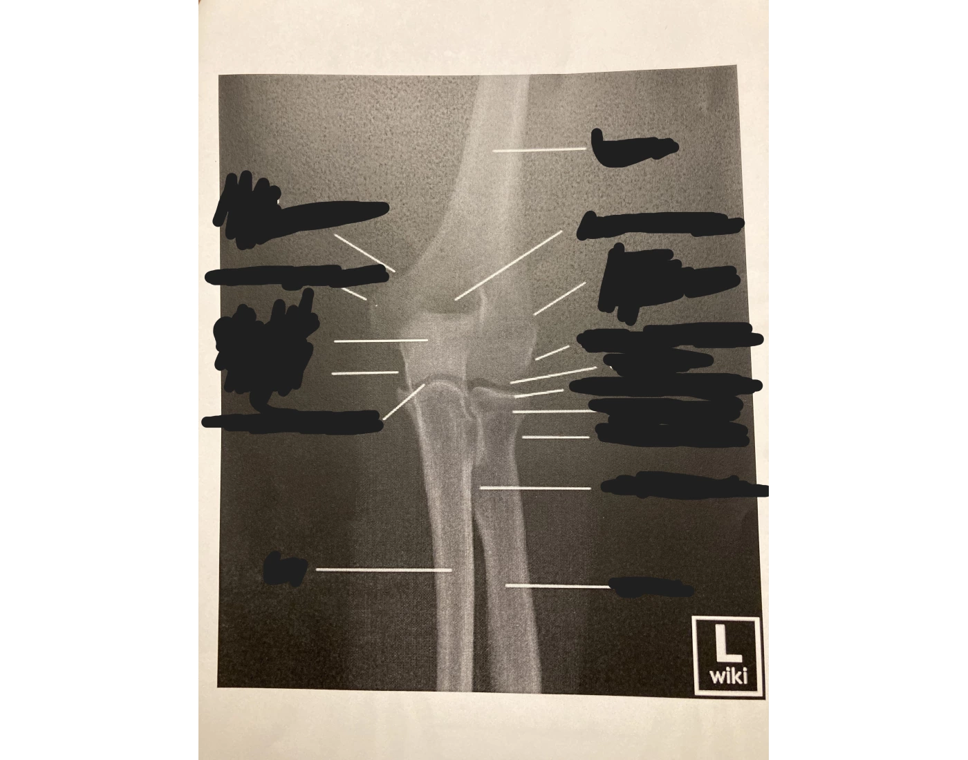 X Ray Of Forearm X Ray Of Forearm