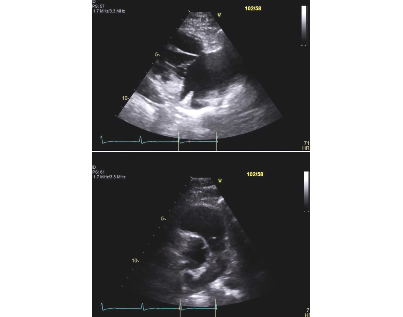 PLAX RV Inflow & Outflow VIew Quiz