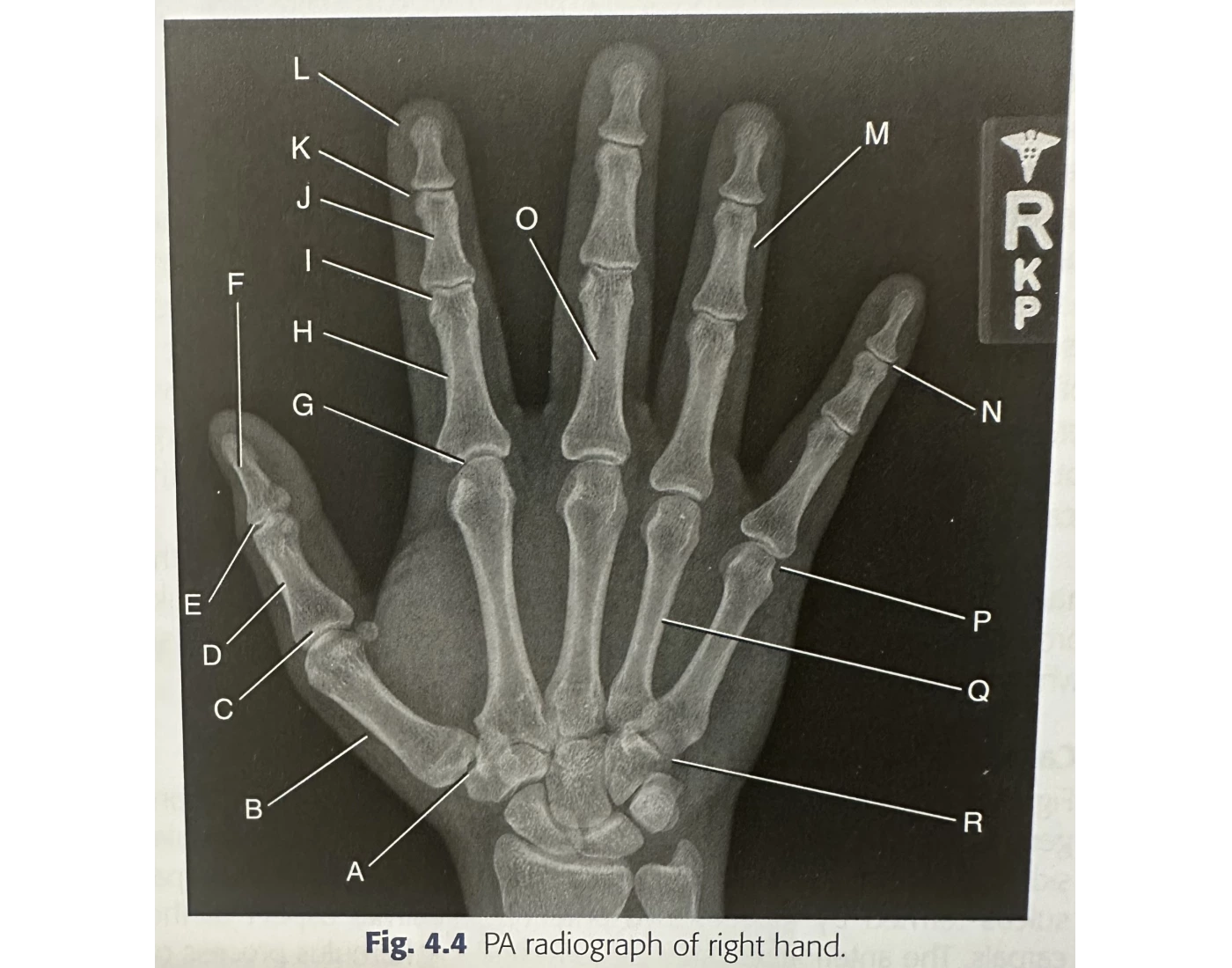 Normal Pa Hand Radiograph PA radiograph of right hand Quiz