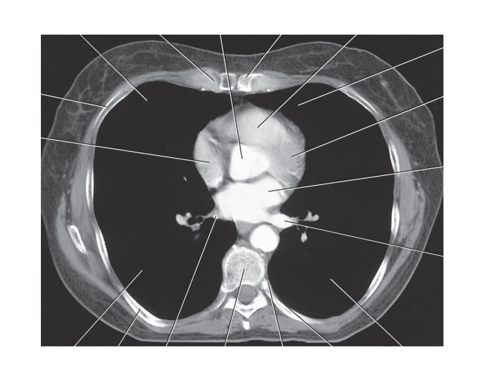 Left Atrium Rupture Ct Axial CT of left atrium Quiz