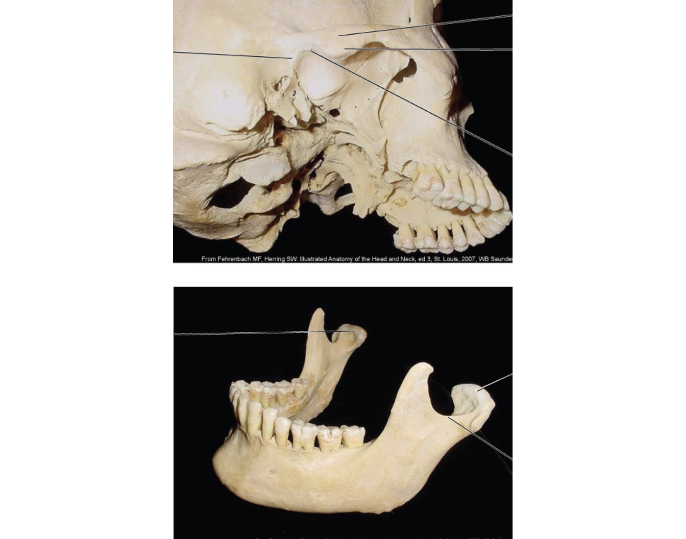 TMJ articulating surface — Printable Worksheet