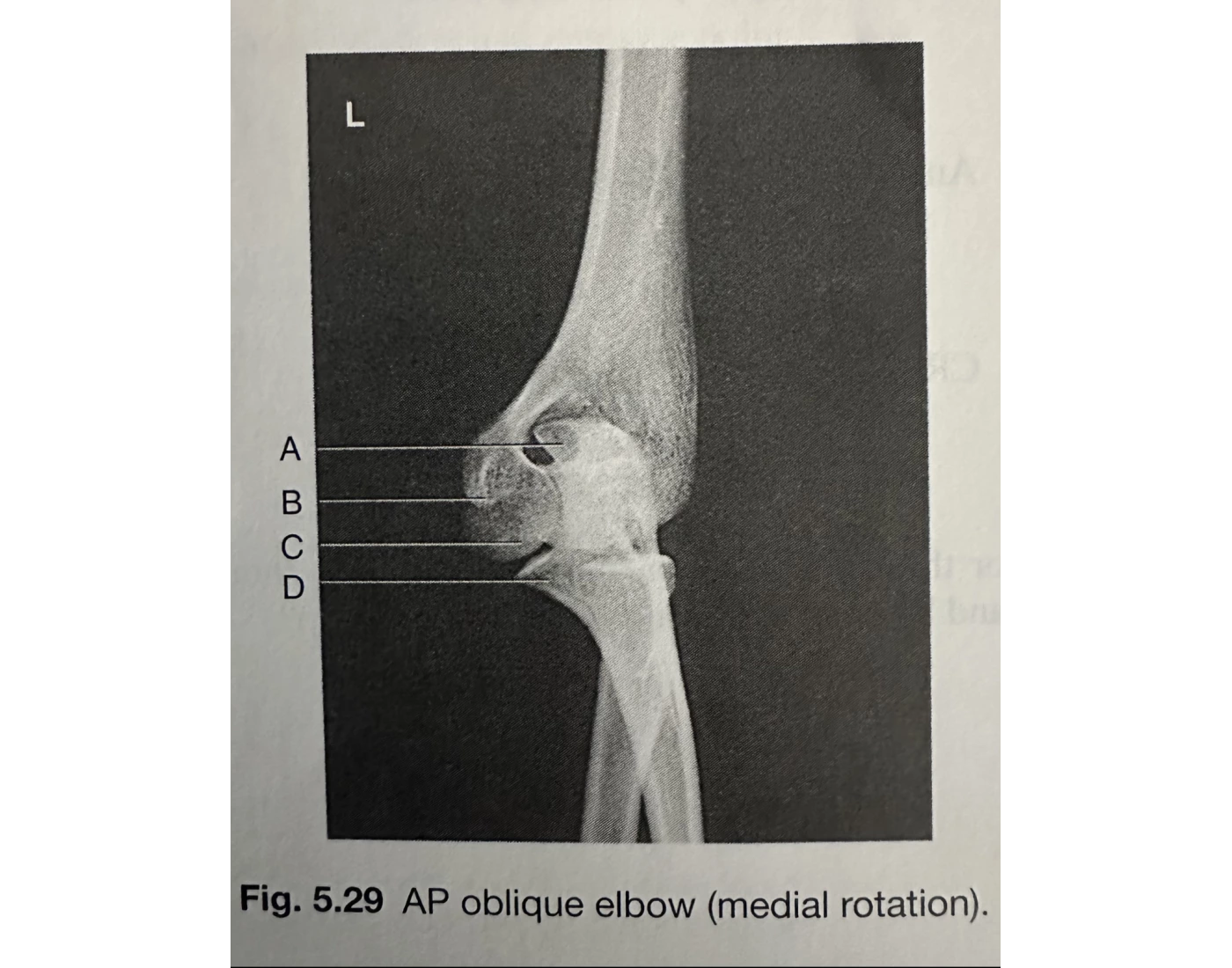 AP Oblique Elbow (Medial Rotation) Quiz
