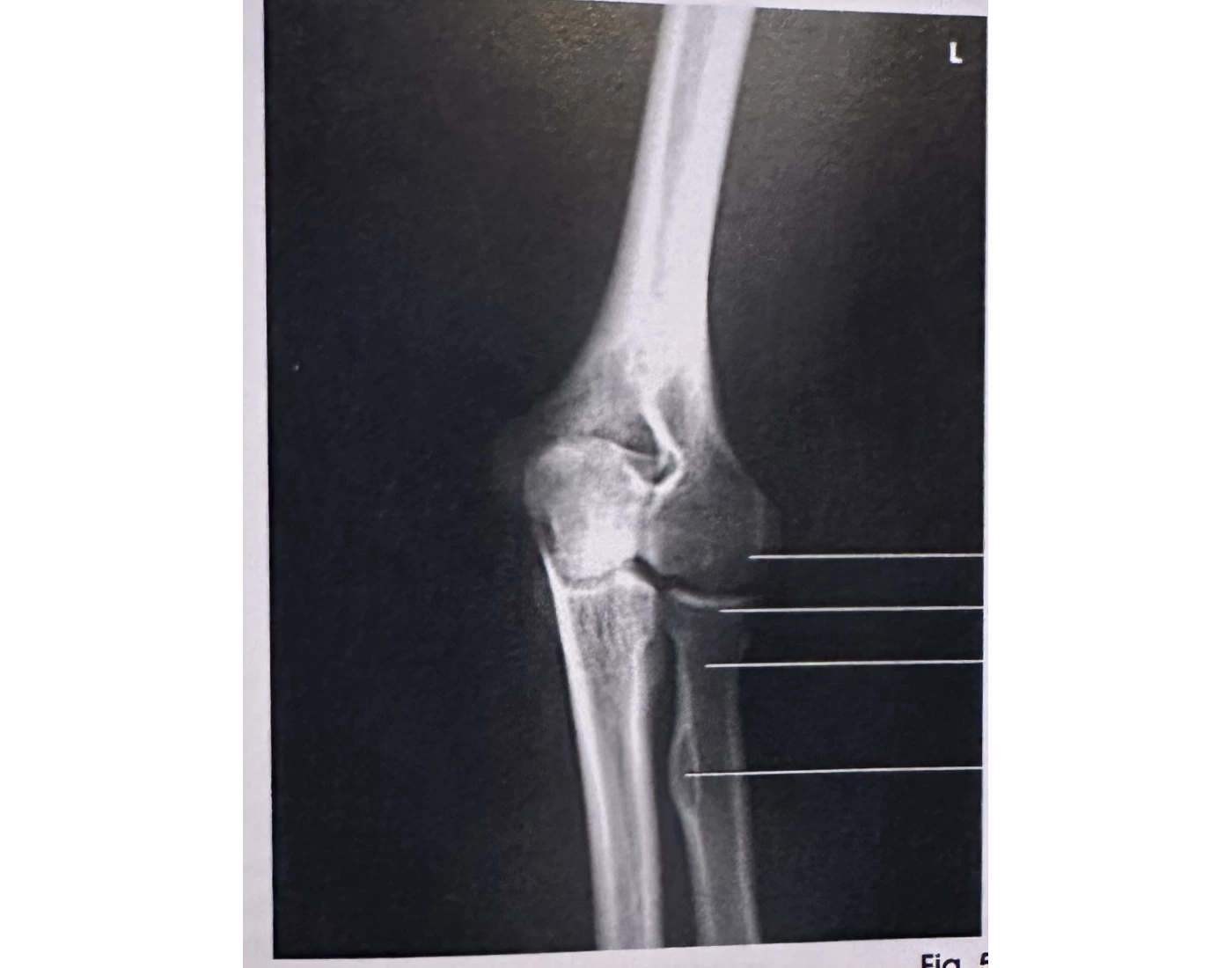 Lateral Rotation Elbow Positioning AP Oblique Elbow (Lateral Rotation) Quiz