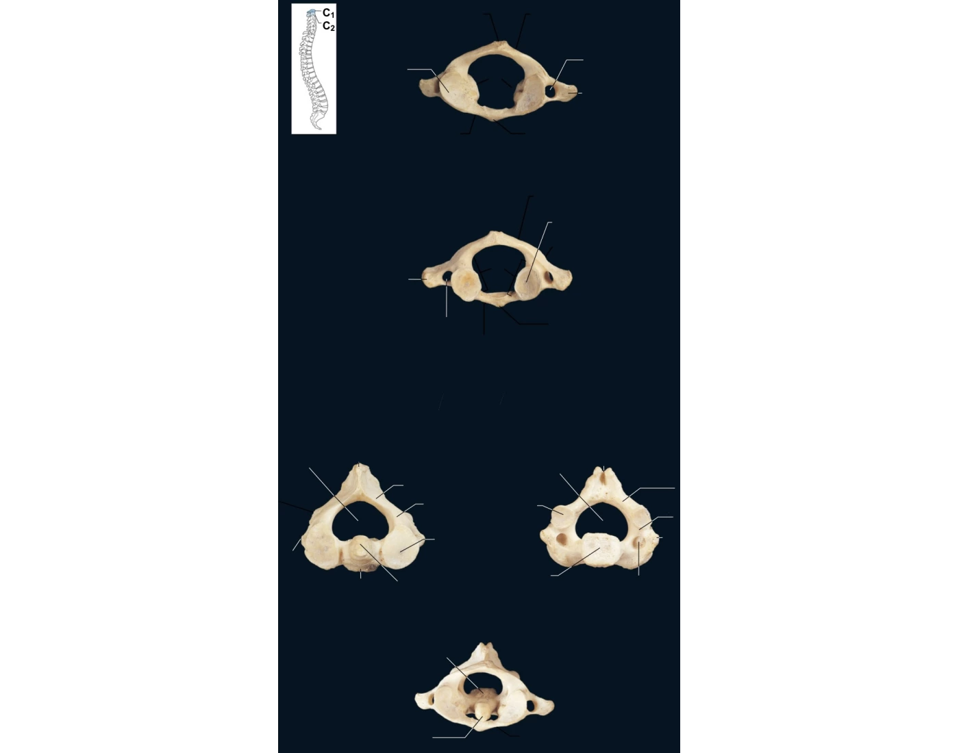 Atlas and Axis Bone Markings Quiz