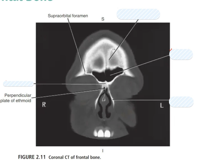 Coronal view of frontal bone — Printable Worksheet