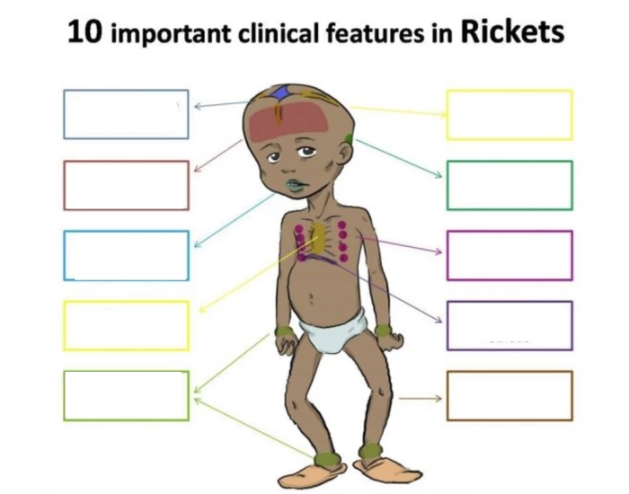10 important clinical features in rickets Quiz