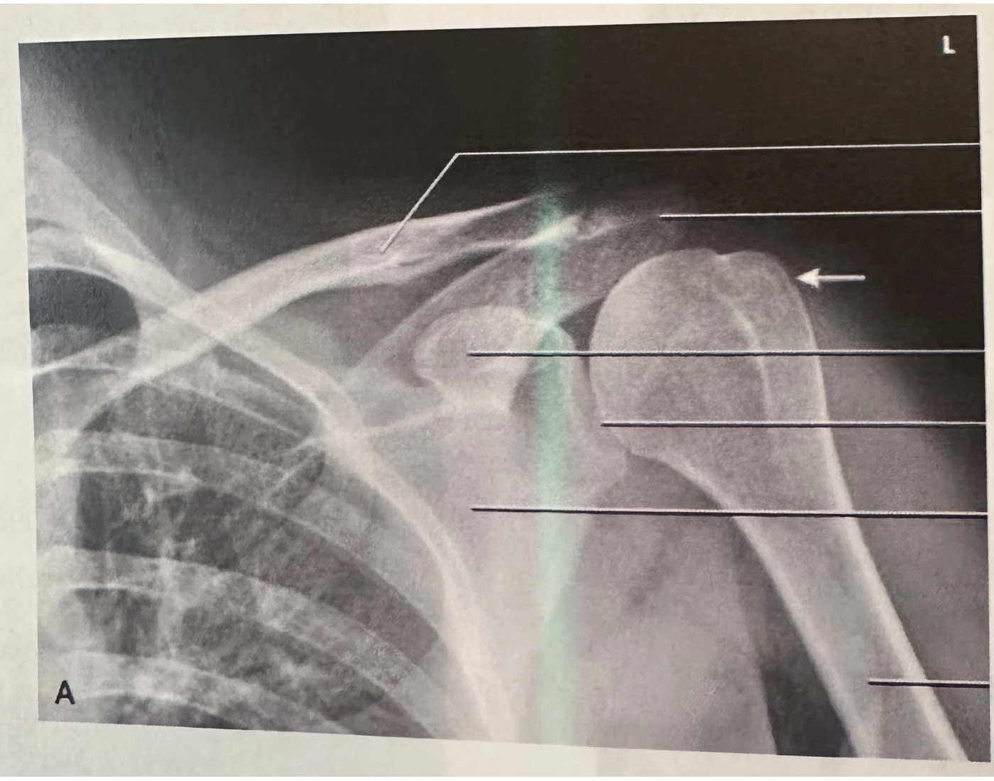 AP Shoulder Anatomy Quiz