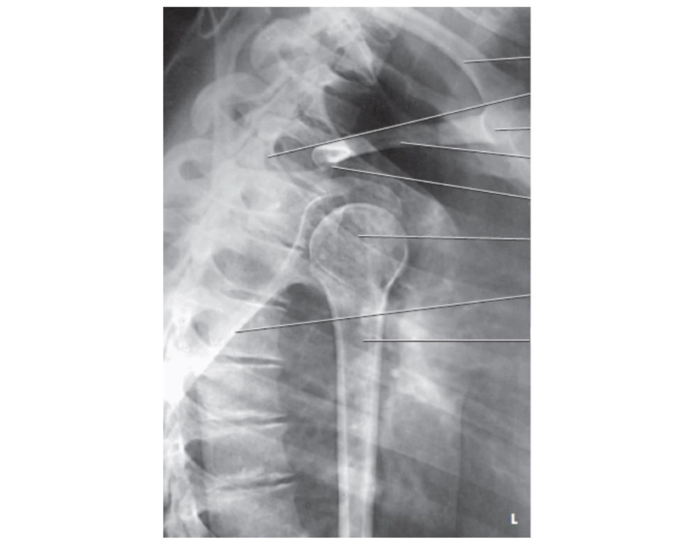 Transthoracic Lateral Shoulder (Lawrence Method) Quiz