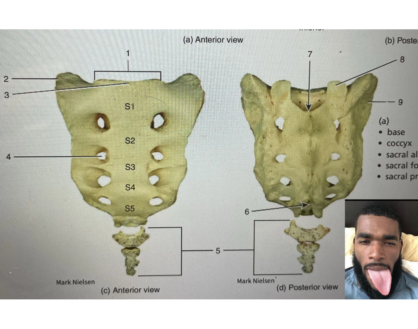 Auricular Surface Sacral Hiatus Quiz