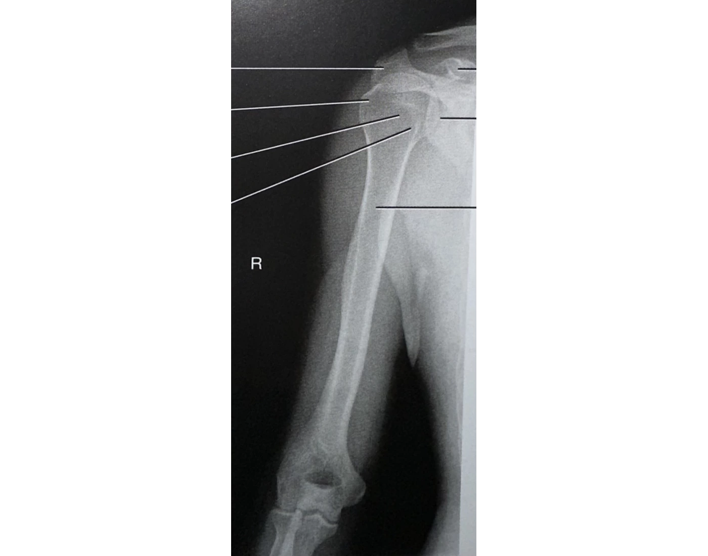 Normal Ap Humerus AP Humerus X-ray anatomy Quiz