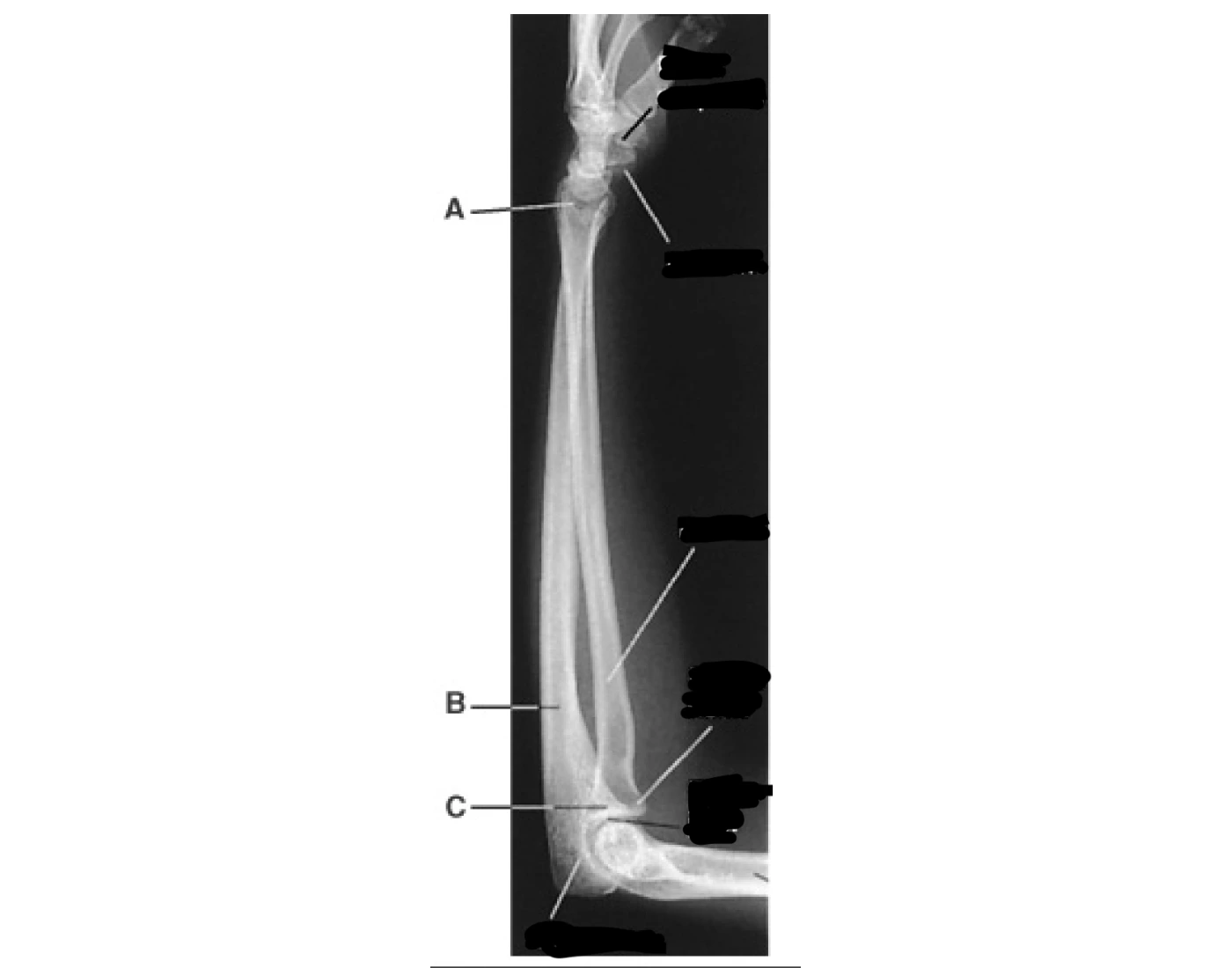 lateral forearm Quiz