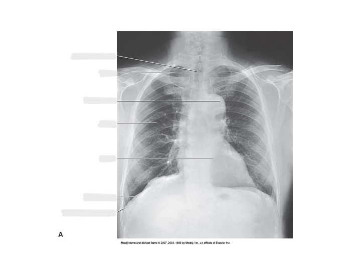 Labeling Radiograph PA Chest Radiograph Labeling Quiz