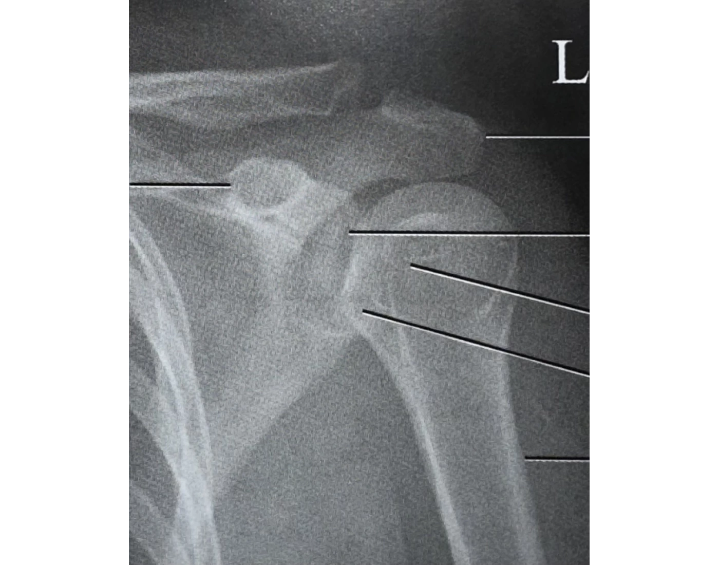 Shoulder Internal And External Rotation Radiograph Internal rotation shoulder X-ray anatomy Quiz