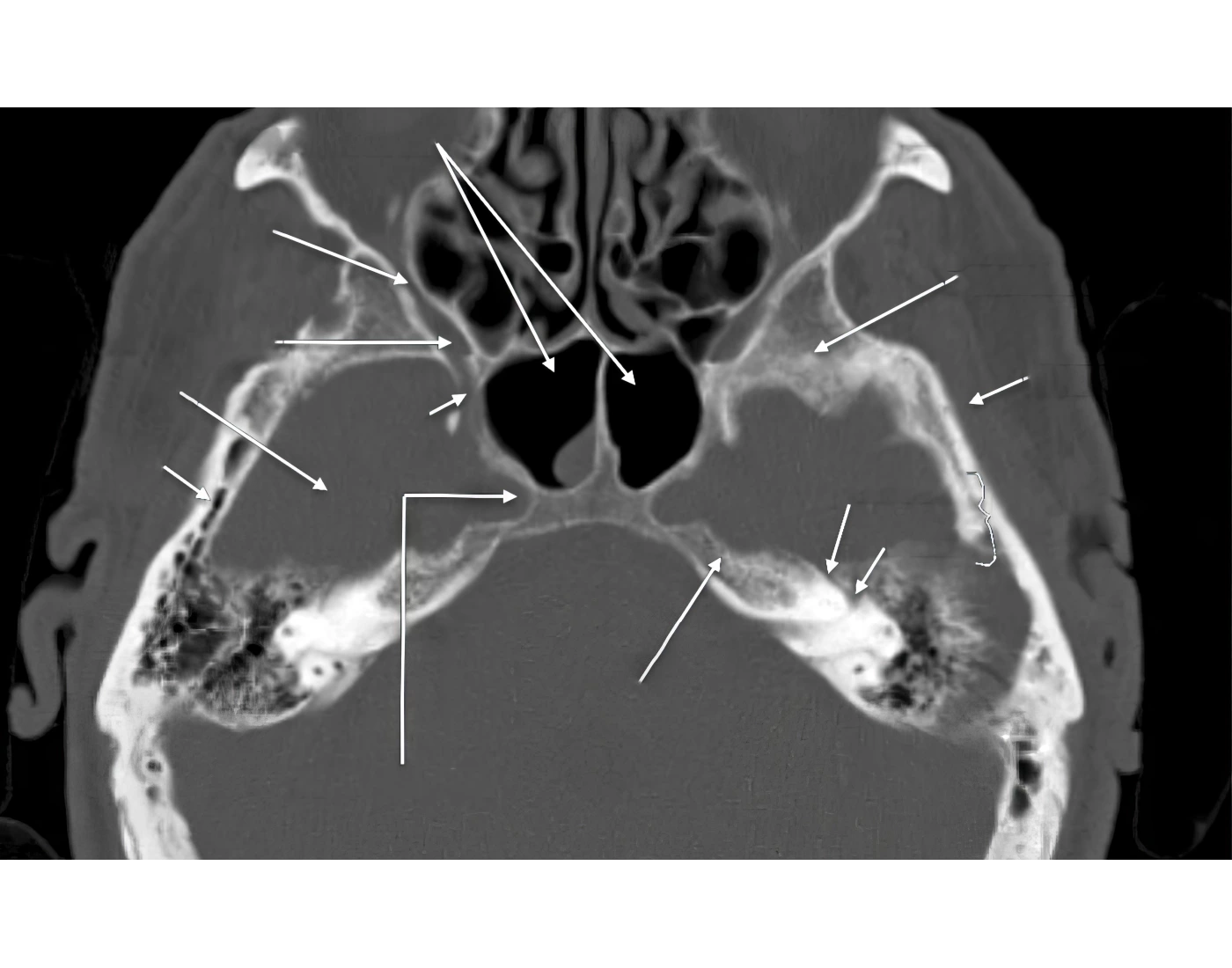 Axial CT Slice Through The Foramen Rotundum Quiz axial-ct-slice-through-the-foramen-rotundum-quiz