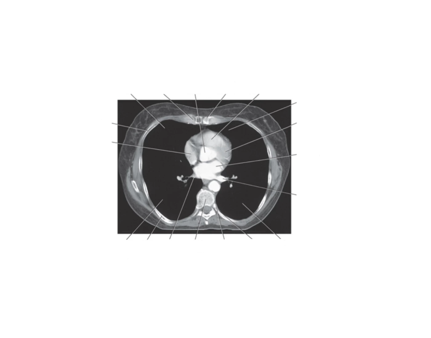 Ct Scan Worksheet.pdf Figure 6.6 Axial CT of sternum — Printable Worksheet