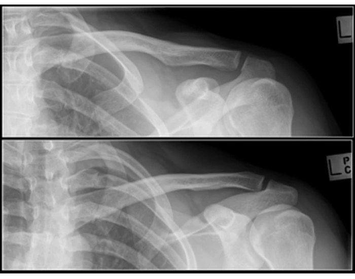 AP and AP Axial Clavicle Quiz