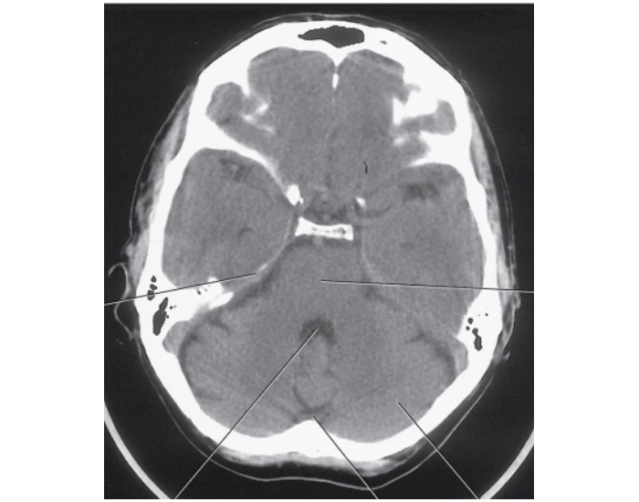3.14 Axial CT of fourth ventricle. Quiz