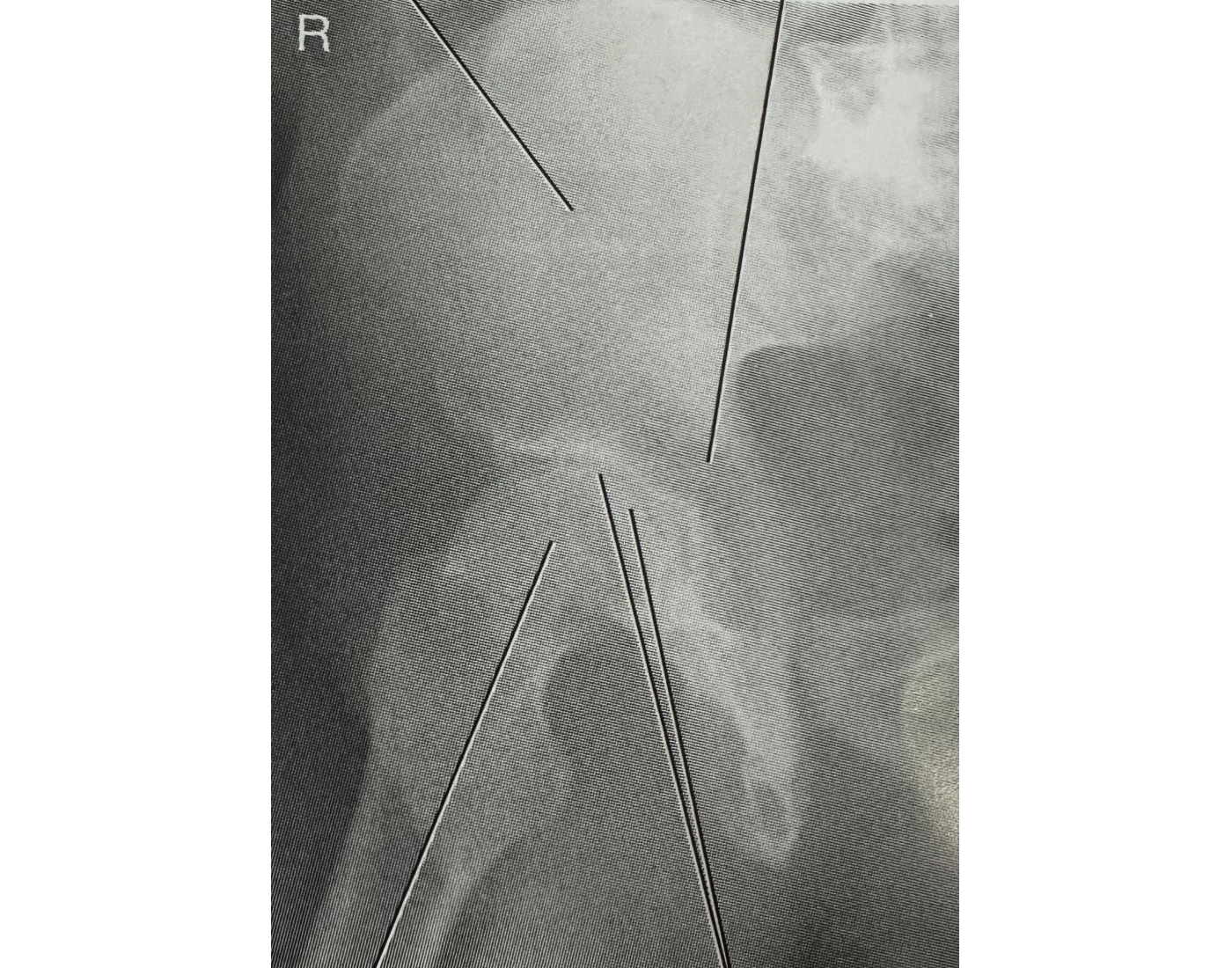 Xr Rpo View RPO Downside Acetabulum X-ray Quiz