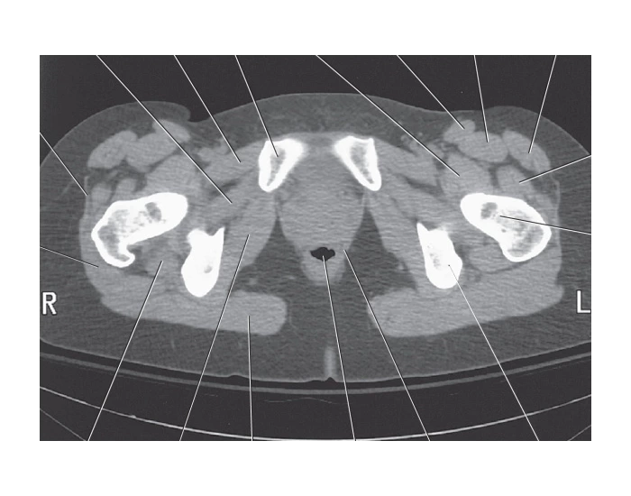 Muscle Defect Ct Axial CT with gluteus and obturator muscles Quiz