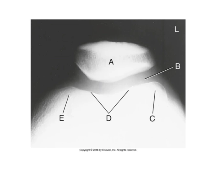 Tangential Patella: Settegast Method Quiz