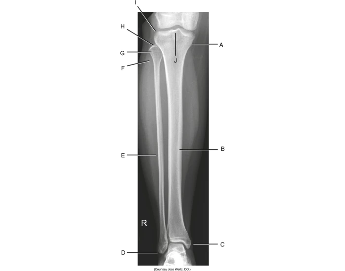 BT AP TIBIA & FIBULA FIG 6.29 Quiz