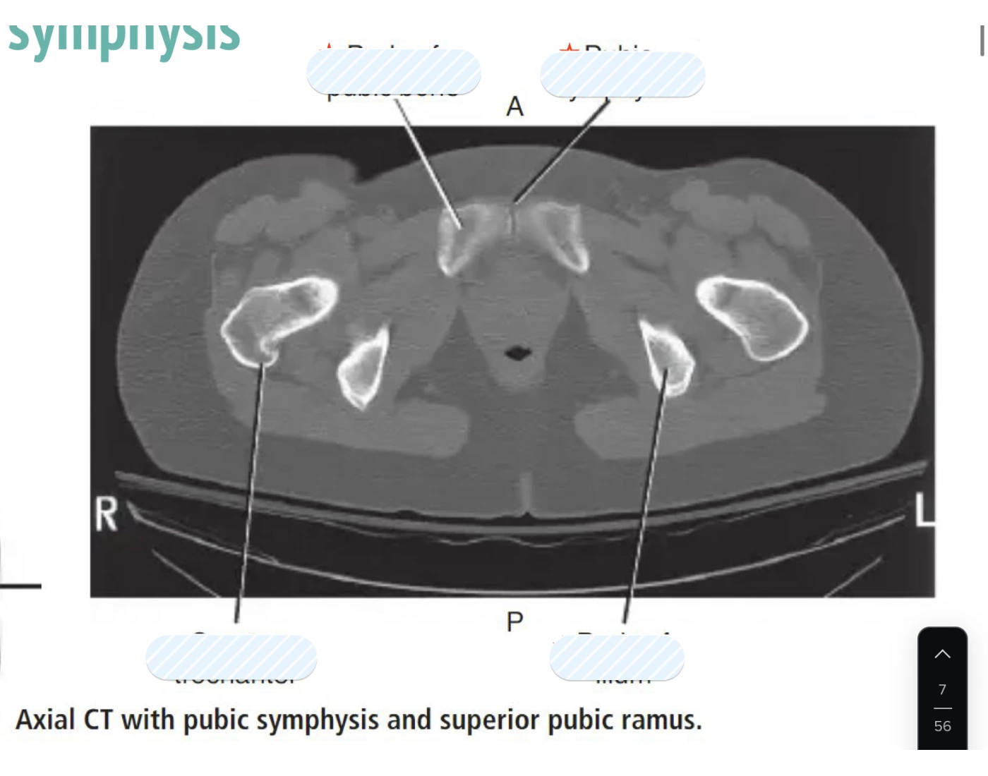 Axial CT with pubic symphysis Quiz