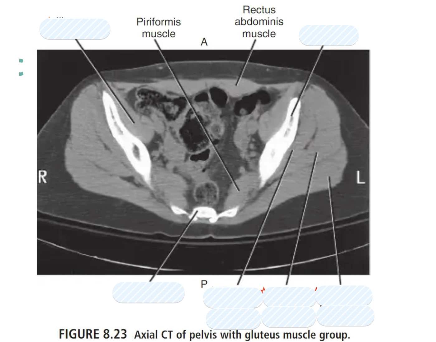 Muscle Defect Ct Axial CT of pelvis with gluteus muscle Quiz