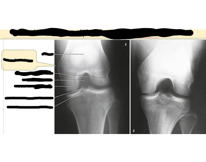 PA Axial Intercondylar Fossa Quiz