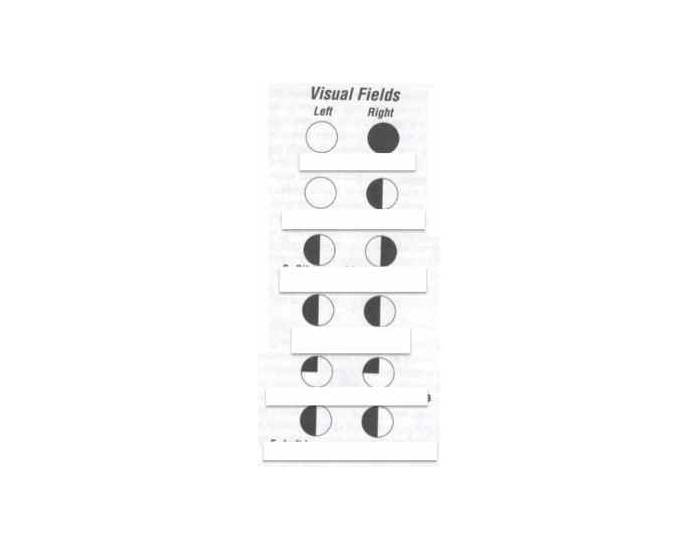 Visual Field Deficits Quiz Visual field deficits quiz